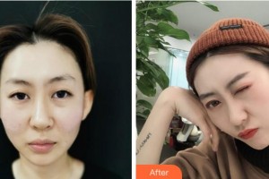 杭州啟美醫(yī)療美容醫(yī)院黃偉杰整形價(jià)格表附埋線提升案例展示