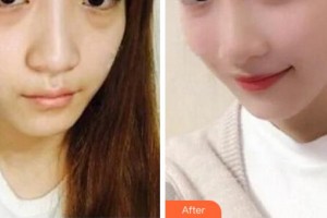 杭州啟美醫(yī)療美容醫(yī)院嚴(yán)志平整形價(jià)格表附埋線提升案例展示