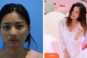 杭州啟美醫(yī)療美容醫(yī)院苗強(qiáng)整形價(jià)格表附埋線提升案例展示