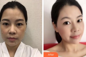 杭州啟美醫(yī)療美容醫(yī)院王盛波整形價(jià)格表附埋線提升案例展示