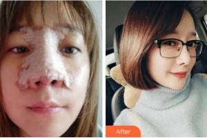 杭州蕭山區(qū)第一人民醫(yī)院整形燒傷科盧力整形價(jià)格表附鼻部綜合案例展示