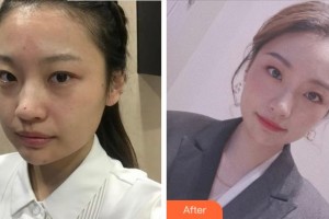 杭州藝星醫(yī)療美容醫(yī)院柏亞萍整形價(jià)格表附激光祛斑案例展示