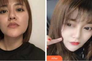 杭州藝星醫(yī)療美容醫(yī)院譚琳整形價(jià)格表附埋線提升案例展示