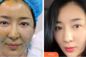 杭州維多利亞醫(yī)療美容醫(yī)院李鶯整形價(jià)格表附埋線提升案例展示