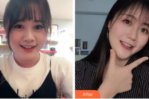 杭州維多利亞醫(yī)療美容醫(yī)院施長(zhǎng)溪整形價(jià)格表附金屬托槽矯正案例展示