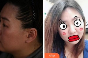 杭州時(shí)光醫(yī)療美容醫(yī)院鄭曉輝整形價(jià)格表附埋線提升案例展示