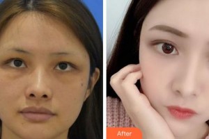 杭州珍美顏醫(yī)療美容診所賈恩榮整形價(jià)格表附埋線提升案例展示