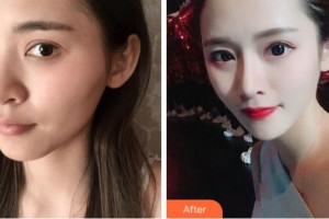 杭州維多利亞醫(yī)療美容醫(yī)院方葉琴整形價(jià)格表附假體隆鼻案例展示