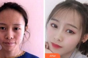 杭州維多利亞醫(yī)療美容醫(yī)院鐘鋒整形價(jià)格表附埋線提升案例展示