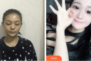 杭州艾菲醫(yī)療美容門(mén)診部鄭義澤整形價(jià)格表附種植發(fā)際線案例展示