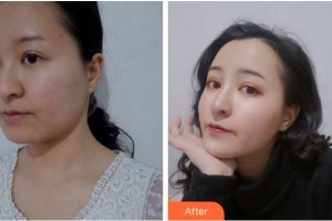 杭州艾菲醫(yī)療美容門(mén)診部樸元基整形價(jià)格表附埋線提升案例展示