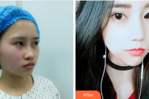 杭州顏術(shù)悅?cè)葆t(yī)療美容診所付俊整形價(jià)格表附埋線提升案例展示