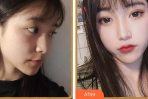 杭州顏術(shù)悅?cè)葆t(yī)療美容診所蘭巖菊整形價(jià)格表附埋線提升案例展示