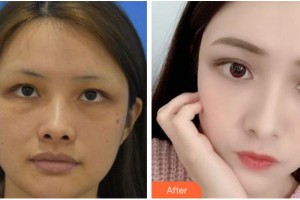 杭州顏術(shù)悅?cè)葆t(yī)療美容診所嚴(yán)后友整形價(jià)格表附埋線提升案例展示