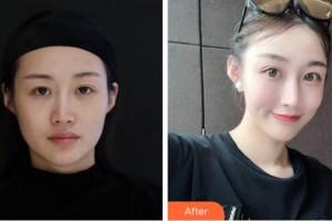 杭州顏術(shù)悅?cè)葆t(yī)療美容診所黃珊珊整形價(jià)格表附埋線提升案例展示