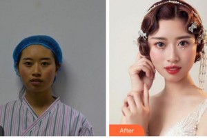 杭州顏術(shù)悅?cè)葆t(yī)療美容診所宋為民整形價(jià)格表附埋線提升案例展示