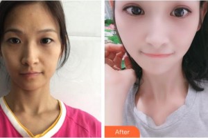 杭州格萊美整形美容醫(yī)院鄭小紅整形價(jià)格表附眼部綜合案例展示