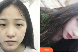 杭州珍美顏醫(yī)療美容診所沈明強(qiáng)整形價(jià)格表附切開(kāi)雙眼皮案例展示