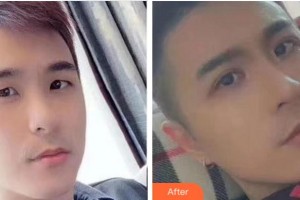 杭州珍美顏醫(yī)療美容診所陳濤整形價(jià)格表附眼部綜合案例展示