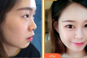 杭州珍美顏醫(yī)療美容診所謝菁整形價(jià)格表附眼部綜合案例展示