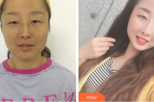 杭州黛雅醫(yī)療美容診所何冬梅整形價(jià)格表附內(nèi)切祛眼袋案例展示