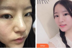 杭州格萊美整形美容醫(yī)院張霞飛整形價(jià)格表附切開(kāi)雙眼皮案例展示