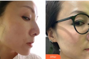 杭州格萊美整形美容醫(yī)院金鳳茹整形價(jià)格表附埋線提升案例展示