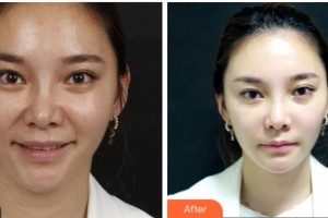 杭州時(shí)光醫(yī)療美容醫(yī)院鄭曉暉整形價(jià)格表附埋線提升案例展示