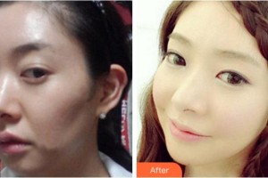 杭州麗星醫(yī)療美容診所金廷炫整形價(jià)格表附埋線提升案例展示