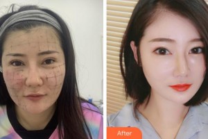 杭州麗星醫(yī)療美容診所金榮敏整形價(jià)格表附熱瑪吉案例展示