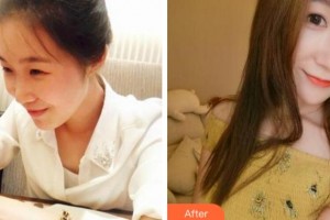 杭州麗星醫(yī)療美容診所鄭心媛整形價(jià)格表附熱瑪吉案例展示