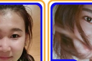 杭州冰美醫(yī)療美容醫(yī)院徐一波整形價(jià)格表附硅膠隆鼻案例展示