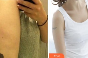 杭州冰美醫(yī)療美容醫(yī)院樓善葉整形價(jià)格表附吸脂案例展示