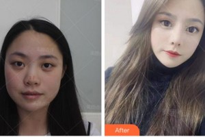 杭州善慈醫(yī)療美容診所曾舉整形價(jià)格表附假體隆鼻案例展示