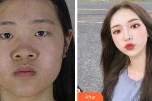 杭州華廈眼科醫(yī)院黃旭整形價(jià)格表附眼部綜合案例展示