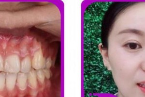 杭州美奧口腔門(mén)診部張彼得整形價(jià)格表附牙齒隱形矯正案例展示