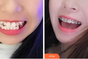 杭州美奧口腔門(mén)診部高思奇整形價(jià)格表附金屬托槽矯正案例展示