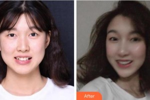 杭州美奧口腔門(mén)診部黃肖整形價(jià)格表附牙齒隱形矯正案例展示