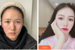 杭州富陽(yáng)柏氏眼科醫(yī)院諸力偉整形價(jià)格表附眼部綜合案例展示