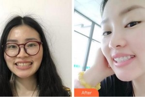 杭州牙科醫(yī)院吳麗萍整形價(jià)格表附金屬托槽矯正案例展示