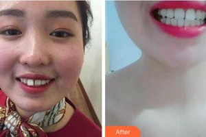 義烏杭州口腔門(mén)診部陳海英整形價(jià)格表附牙齒隱形矯正案例展示