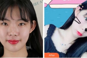 杭州薇琳醫(yī)療美容醫(yī)院劉淑芹整形價格表附熱瑪吉案例展示