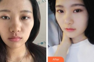 杭州嬋之媛醫(yī)療美容診所崔在爀整形價格表附熱瑪吉案例展示