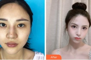 杭州安歆醫(yī)療美容醫(yī)院馮志丹整形價格表附下瞼整形案例展示