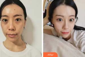 杭州睿妍醫(yī)療美容診所茅東升整形價格表附埋線提升案例展示