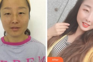 杭州富陽柏氏眼科醫(yī)院馬麗卿整形價格表附內切祛眼袋案例展示