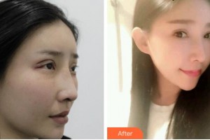 杭州德視佳眼科門診部薛艷珍整形價格表附切開雙眼皮案例展示