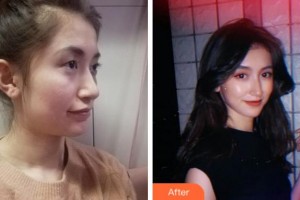 杭州富陽柏氏眼科醫(yī)院謝毅杰整形價格表附眼部綜合案例展示