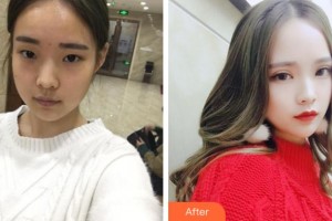 杭州求是眼科醫(yī)院張惠成整形價格表附切開雙眼皮案例展示