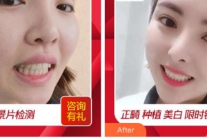杭州品凱口腔醫(yī)院沈惠華整形價格表附貴金屬烤瓷牙案例展示